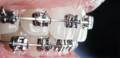 closeup dental braces on teeth