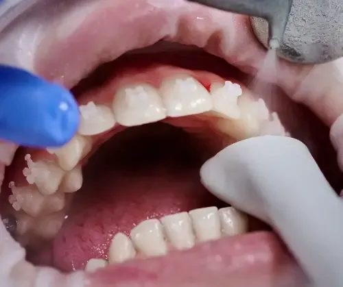 dentist doing professional teeth cleaning