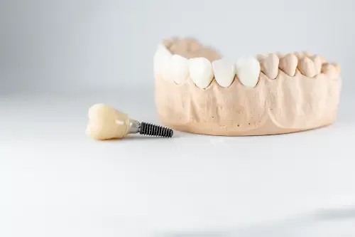 model of an implant