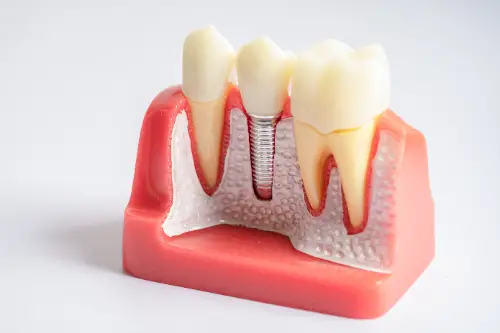 dental implants in an artificial tooth