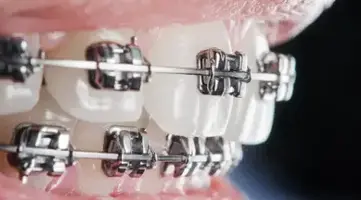 Close-up of dental braces on teeth