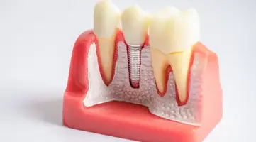 Dental implant positioned in an artificial jaw