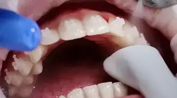 Dentist performing professional teeth cleaning
