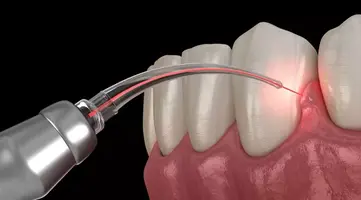 Laser gum disease treatment procedure